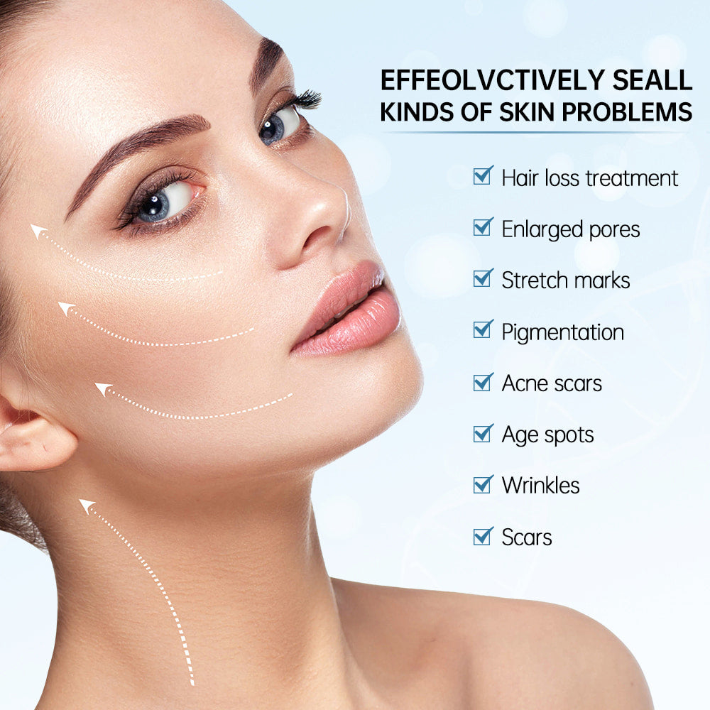 Woman showing results of microneedling for treating skin issues such as large pores, scars, acne scars, pigmentation spots, wrinkles, and fine lines.