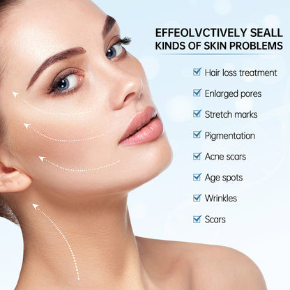 Woman showing results of microneedling for treating skin issues such as large pores, scars, acne scars, pigmentation spots, wrinkles, and fine lines.